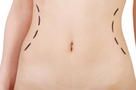 Abdominoplastia – secretul unui abdomen ferm și conturat